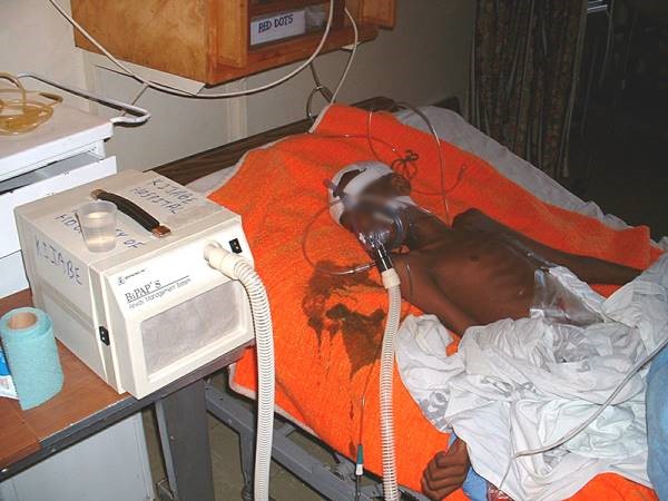 Child with sepsis at a hospital bed